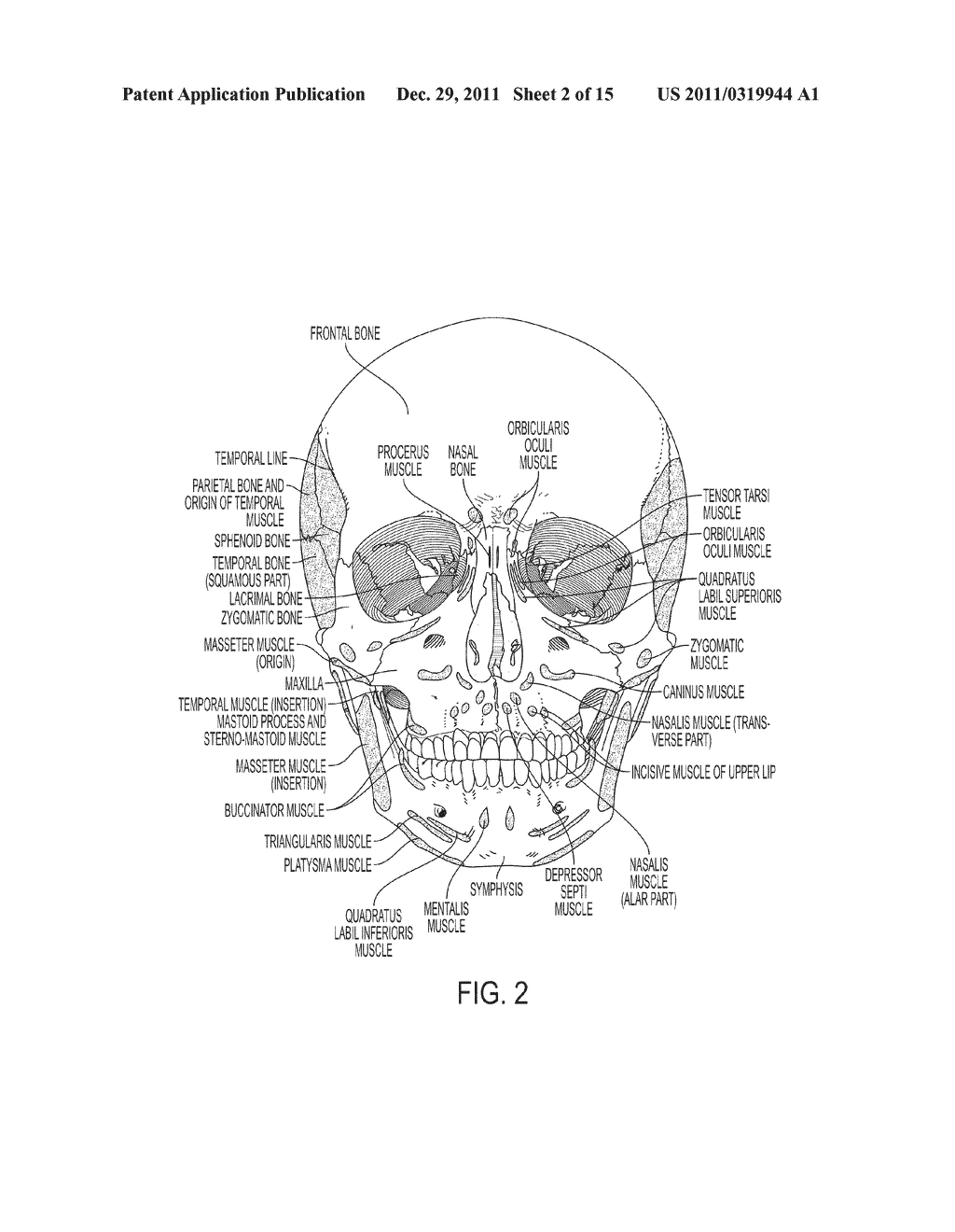 Submuscular Facial Fixation (Myo-Osseous Fixation) Using Microincision     Microscrew Device, Injectable Glues and Adhesives, and Method and Device     for Therapy of Migraine and Related Headaches - diagram, schematic, and image 03