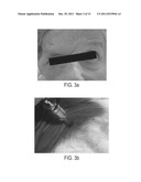 Submuscular Facial Fixation (Myo-Osseous Fixation) Using Microincision     Microscrew Device, Injectable Glues and Adhesives, and Method and Device     for Therapy of Migraine and Related Headaches diagram and image