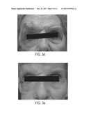 Submuscular Facial Fixation (Myo-Osseous Fixation) Using Microincision     Microscrew Device, Injectable Glues and Adhesives, and Method and Device     for Therapy of Migraine and Related Headaches diagram and image