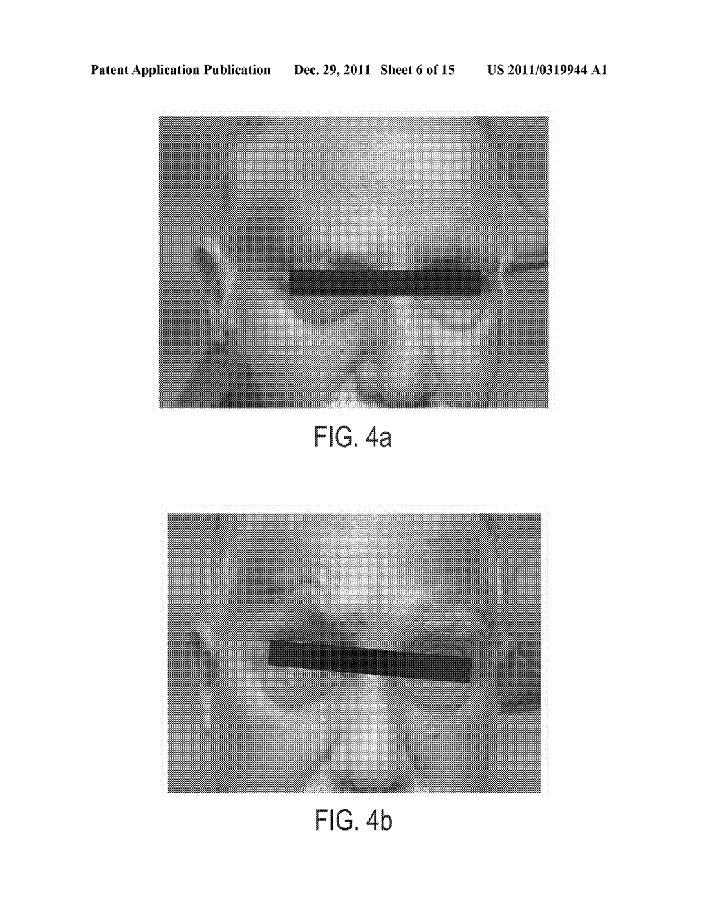 Submuscular Facial Fixation (Myo-Osseous Fixation) Using Microincision     Microscrew Device, Injectable Glues and Adhesives, and Method and Device     for Therapy of Migraine and Related Headaches - diagram, schematic, and image 07