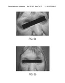 Submuscular Facial Fixation (Myo-Osseous Fixation) Using Microincision     Microscrew Device, Injectable Glues and Adhesives, and Method and Device     for Therapy of Migraine and Related Headaches diagram and image