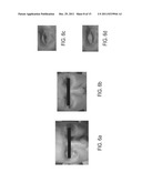 Submuscular Facial Fixation (Myo-Osseous Fixation) Using Microincision     Microscrew Device, Injectable Glues and Adhesives, and Method and Device     for Therapy of Migraine and Related Headaches diagram and image