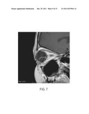 Submuscular Facial Fixation (Myo-Osseous Fixation) Using Microincision     Microscrew Device, Injectable Glues and Adhesives, and Method and Device     for Therapy of Migraine and Related Headaches diagram and image