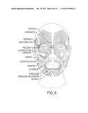 Submuscular Facial Fixation (Myo-Osseous Fixation) Using Microincision     Microscrew Device, Injectable Glues and Adhesives, and Method and Device     for Therapy of Migraine and Related Headaches diagram and image