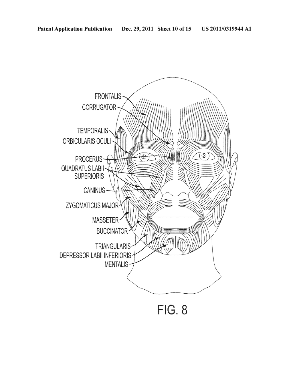 Submuscular Facial Fixation (Myo-Osseous Fixation) Using Microincision     Microscrew Device, Injectable Glues and Adhesives, and Method and Device     for Therapy of Migraine and Related Headaches - diagram, schematic, and image 11