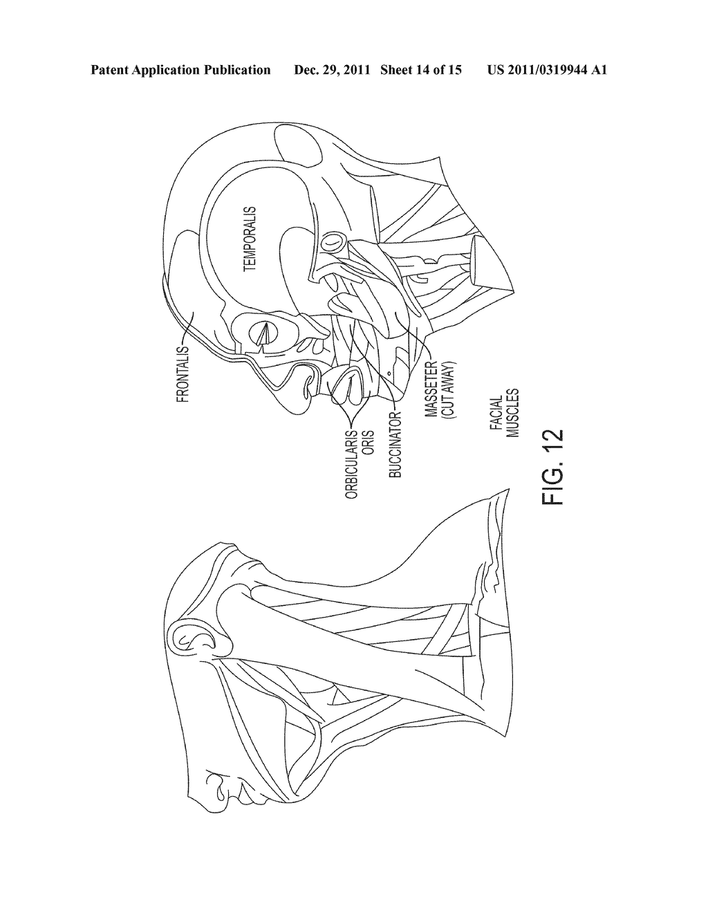 Submuscular Facial Fixation (Myo-Osseous Fixation) Using Microincision     Microscrew Device, Injectable Glues and Adhesives, and Method and Device     for Therapy of Migraine and Related Headaches - diagram, schematic, and image 15