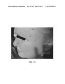 Submuscular Facial Fixation (Myo-Osseous Fixation) Using Microincision     Microscrew Device, Injectable Glues and Adhesives, and Method and Device     for Therapy of Migraine and Related Headaches diagram and image