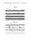 NON-INVASIVE TREATMENT OF BRONCHIAL CONSTRICTION diagram and image