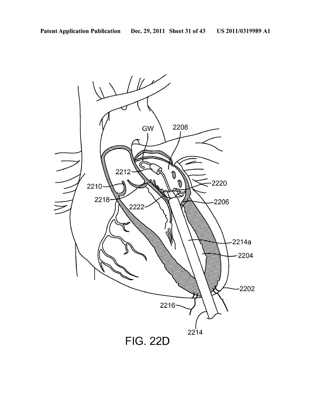 TRANSCATHETER MITRAL VALVE PROSTHESIS - diagram, schematic, and image 32