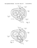 DEVICES, SYSTEMS, AND METHODS FOR SUPPLEMENTING, REPAIRING OR REPLACING A     NATIVE HEART VALVE LEAFLET diagram and image