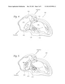 DEVICES, SYSTEMS, AND METHODS FOR SUPPLEMENTING, REPAIRING OR REPLACING A     NATIVE HEART VALVE LEAFLET diagram and image