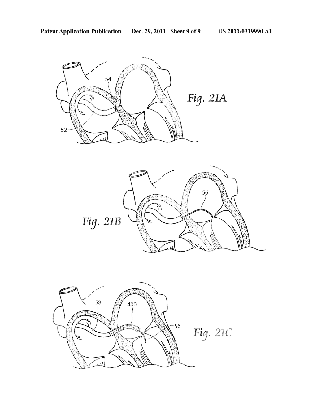 DEVICES, SYSTEMS, AND METHODS FOR SUPPLEMENTING, REPAIRING OR REPLACING A     NATIVE HEART VALVE LEAFLET - diagram, schematic, and image 10