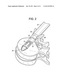 Enhanced Cage Insertion Device diagram and image