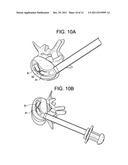 Enhanced Cage Insertion Device diagram and image