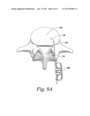 SPINAL FUSION IMPLANT diagram and image