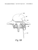 SPINAL FUSION IMPLANT diagram and image