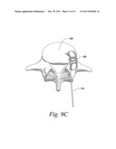 SPINAL FUSION IMPLANT diagram and image