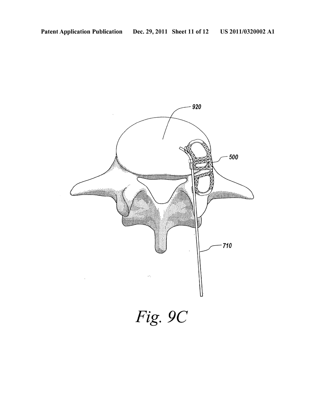 SPINAL FUSION IMPLANT - diagram, schematic, and image 12