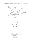 Artificial Spinal Disc diagram and image