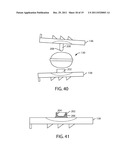 Artificial Spinal Disc diagram and image