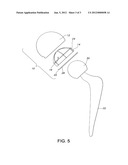 METHOD OF STERILIZING AN ORTHOPAEDIC IMPLANT diagram and image