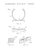 INNOVATIVE AND AESTHETIC ALTERNATIVE TO TRADITIONAL SPECTACLE CORRECTION     THAT OBVIATES THE NOSE/NASAL BRIDGE AND EARS FOR PLACEMENT diagram and image