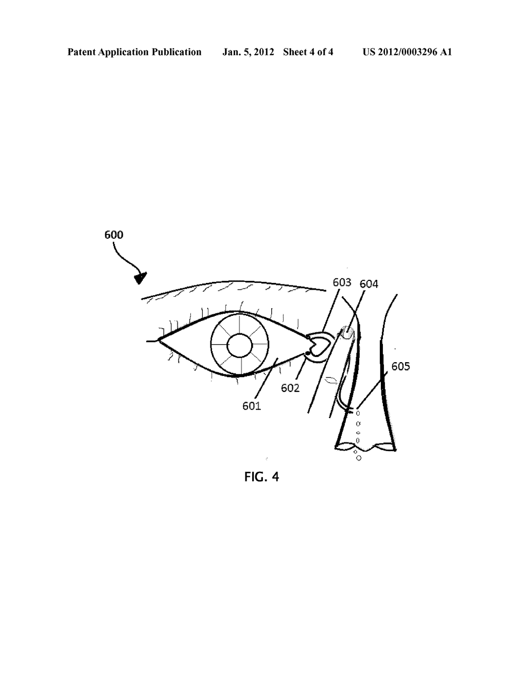 NEW METHODS OF TREATING DRY EYE SYNDROME - diagram, schematic, and image 05