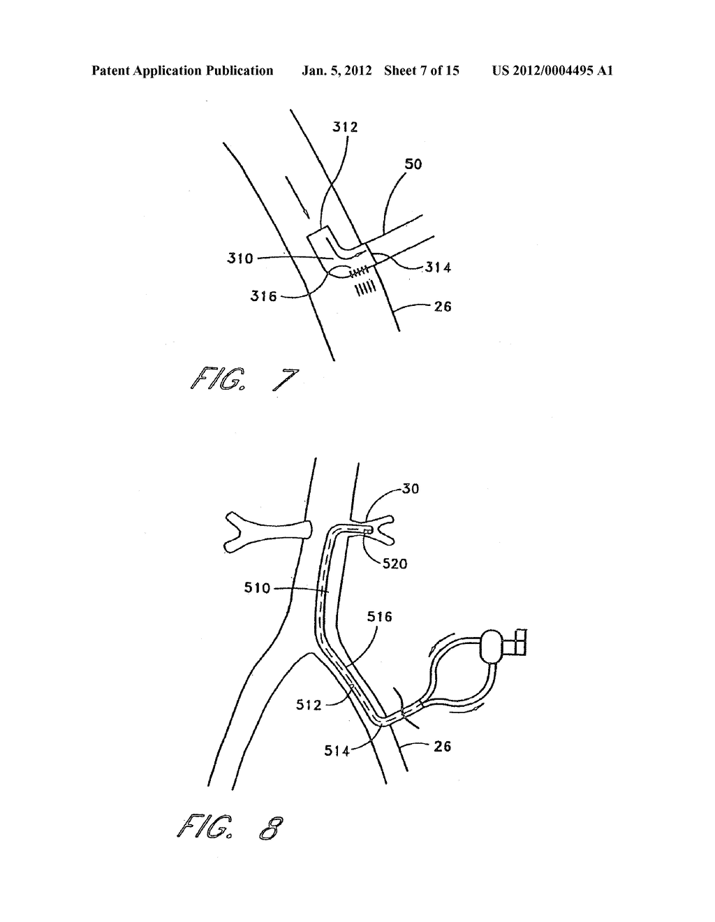 IMPLANTABLE HEART ASSIST SYSTEM AND METHOD OF APPLYING SAME - diagram, schematic, and image 08