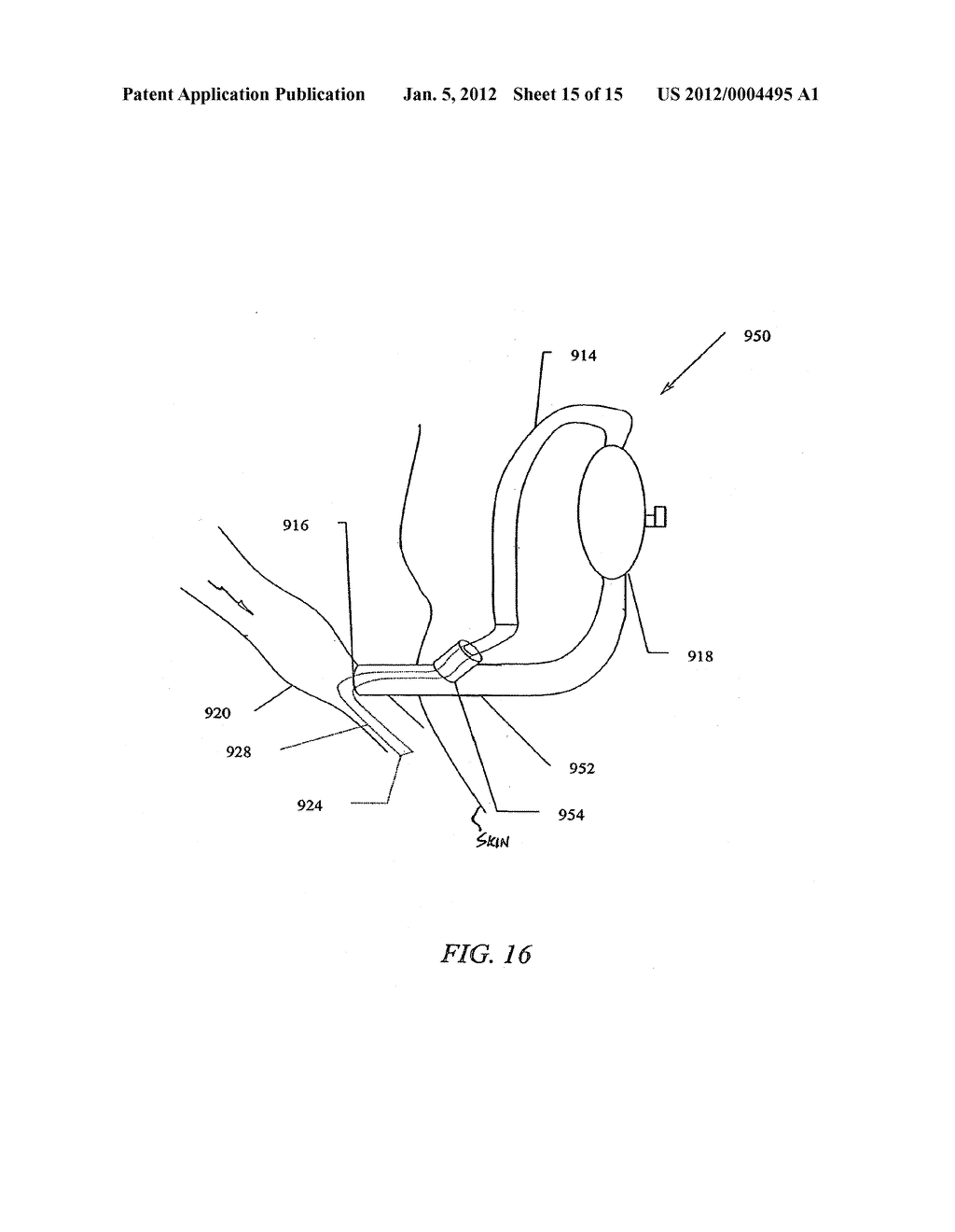 IMPLANTABLE HEART ASSIST SYSTEM AND METHOD OF APPLYING SAME - diagram, schematic, and image 16