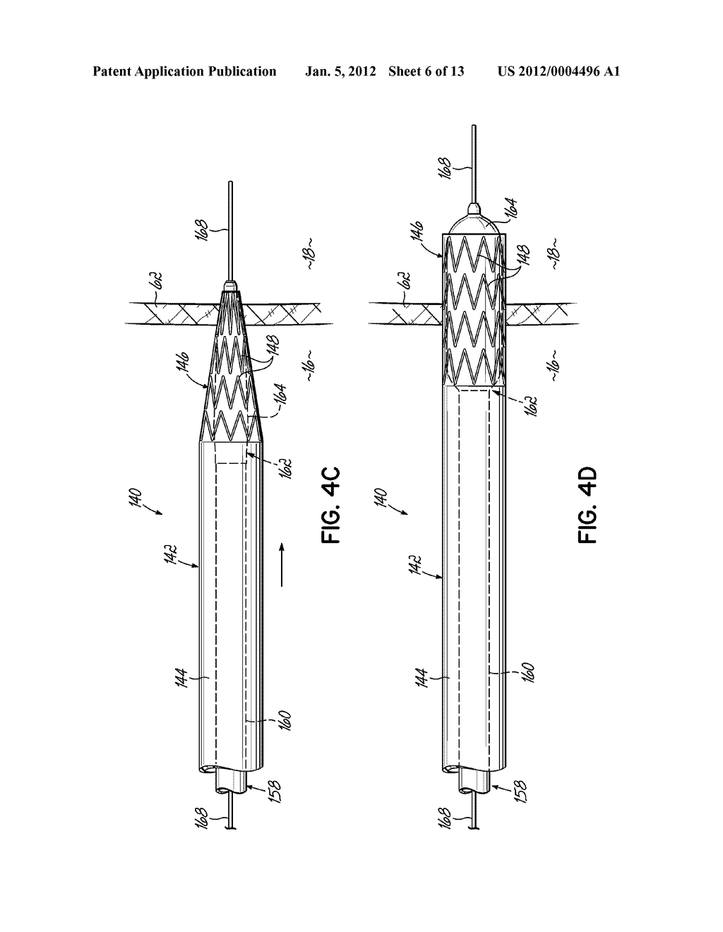 CANNULA LINED WITH TISSUE IN-GROWTH MATERIAL AND METHOD OF USING THE SAME - diagram, schematic, and image 07