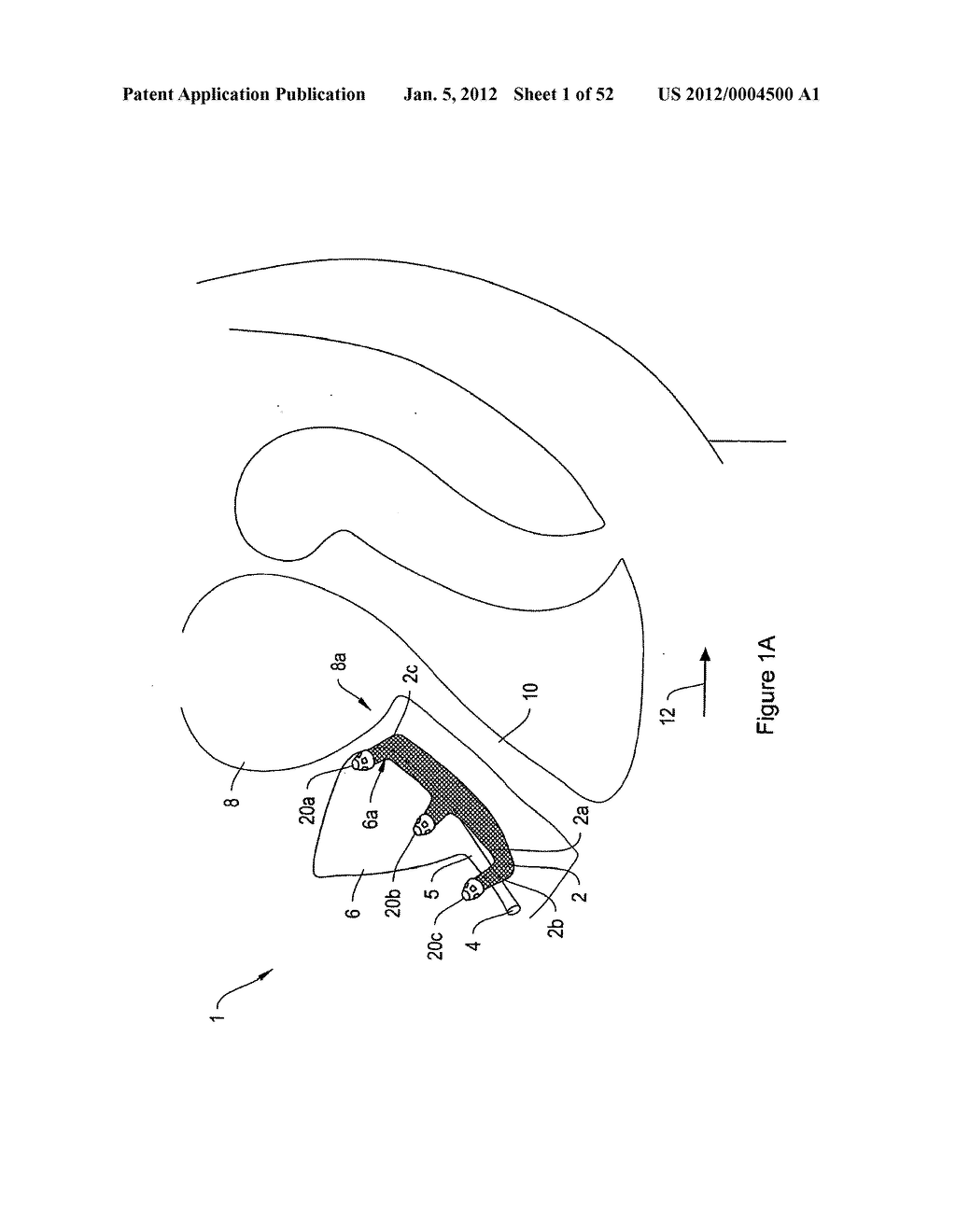 SYSTEMS, DEVICES, AND METHODS FOR SUB-URETHRAL SUPPORT - diagram, schematic, and image 02