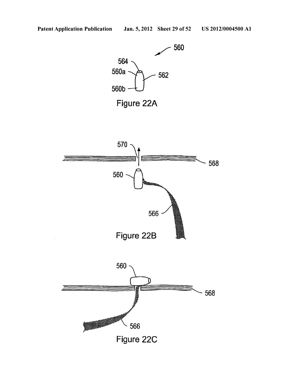 SYSTEMS, DEVICES, AND METHODS FOR SUB-URETHRAL SUPPORT - diagram, schematic, and image 30