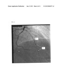 CO-USE OF ENDOLUMINAL DATA AND EXTRALUMINAL IMAGING diagram and image