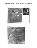 CO-USE OF ENDOLUMINAL DATA AND EXTRALUMINAL IMAGING diagram and image