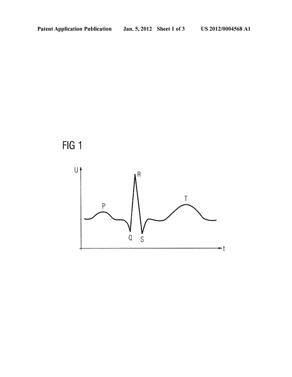 Method for identifying R waves in an ECG signal and an ECG measuring     instrument as well as a magnetic resonance device - diagram, schematic, and image 02