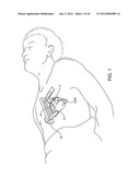 DELIVERING A CONDUIT INTO A HEART WALL TO PLACE A CORONARY VESSEL IN     COMMUNICATION WITH A HEART CHAMBER AND REMOVING TISSUE FROM THE VESSEL OR     HEART WALL TO FACILITATE SUCH COMMUNICATION diagram and image