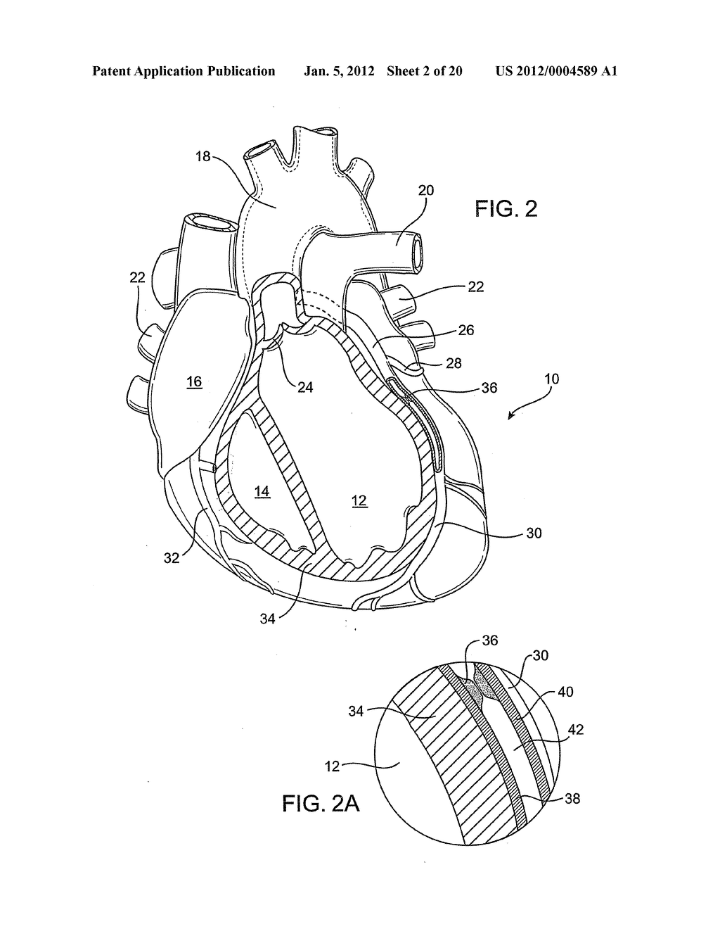 DELIVERING A CONDUIT INTO A HEART WALL TO PLACE A CORONARY VESSEL IN     COMMUNICATION WITH A HEART CHAMBER AND REMOVING TISSUE FROM THE VESSEL OR     HEART WALL TO FACILITATE SUCH COMMUNICATION - diagram, schematic, and image 03