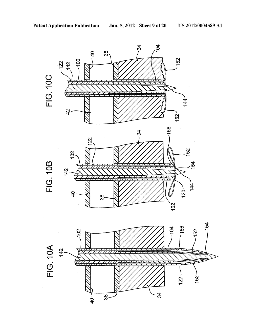 DELIVERING A CONDUIT INTO A HEART WALL TO PLACE A CORONARY VESSEL IN     COMMUNICATION WITH A HEART CHAMBER AND REMOVING TISSUE FROM THE VESSEL OR     HEART WALL TO FACILITATE SUCH COMMUNICATION - diagram, schematic, and image 10