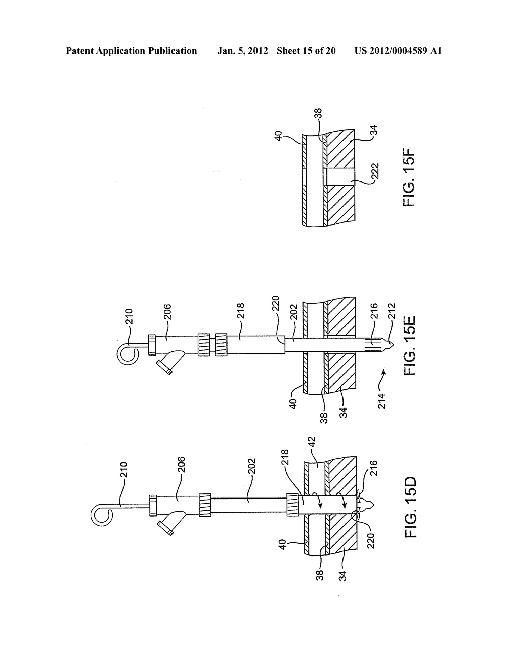 DELIVERING A CONDUIT INTO A HEART WALL TO PLACE A CORONARY VESSEL IN     COMMUNICATION WITH A HEART CHAMBER AND REMOVING TISSUE FROM THE VESSEL OR     HEART WALL TO FACILITATE SUCH COMMUNICATION - diagram, schematic, and image 16