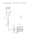 DELIVERING A CONDUIT INTO A HEART WALL TO PLACE A CORONARY VESSEL IN     COMMUNICATION WITH A HEART CHAMBER AND REMOVING TISSUE FROM THE VESSEL OR     HEART WALL TO FACILITATE SUCH COMMUNICATION diagram and image