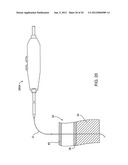 DELIVERING A CONDUIT INTO A HEART WALL TO PLACE A CORONARY VESSEL IN     COMMUNICATION WITH A HEART CHAMBER AND REMOVING TISSUE FROM THE VESSEL OR     HEART WALL TO FACILITATE SUCH COMMUNICATION diagram and image