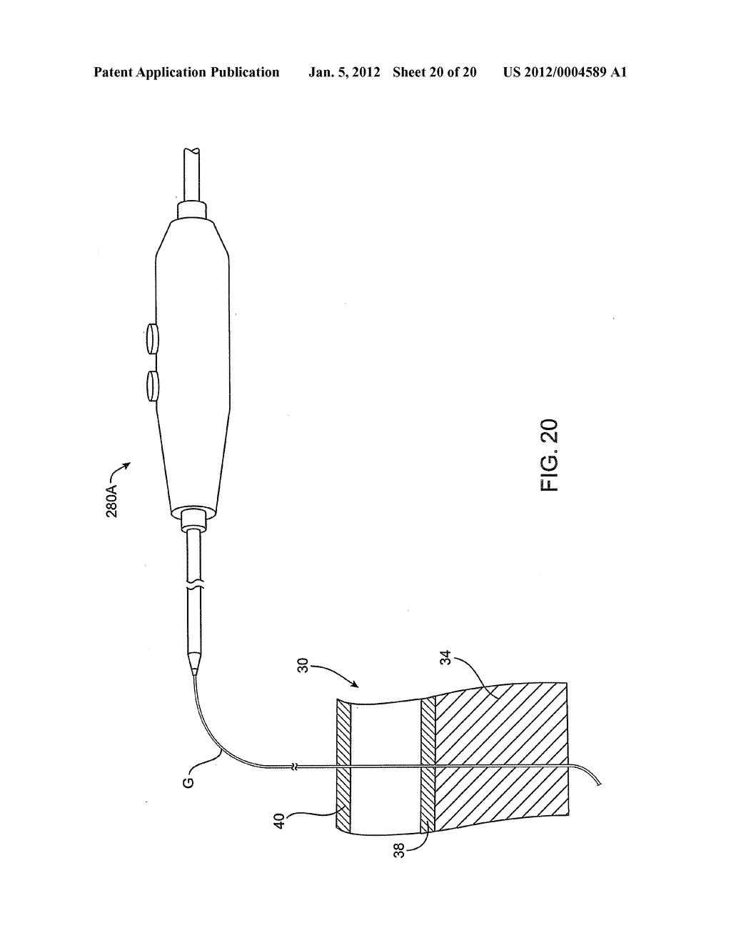 DELIVERING A CONDUIT INTO A HEART WALL TO PLACE A CORONARY VESSEL IN     COMMUNICATION WITH A HEART CHAMBER AND REMOVING TISSUE FROM THE VESSEL OR     HEART WALL TO FACILITATE SUCH COMMUNICATION - diagram, schematic, and image 21