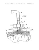 SUBDURAL EVACUATION PORT ASPIRATION DEVICE diagram and image