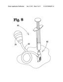 SUBDURAL EVACUATION PORT ASPIRATION DEVICE diagram and image