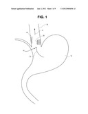 METHODS AND SYSTEMS FOR TREATMENT OF TISSUE IN A BODY LUMEN diagram and image