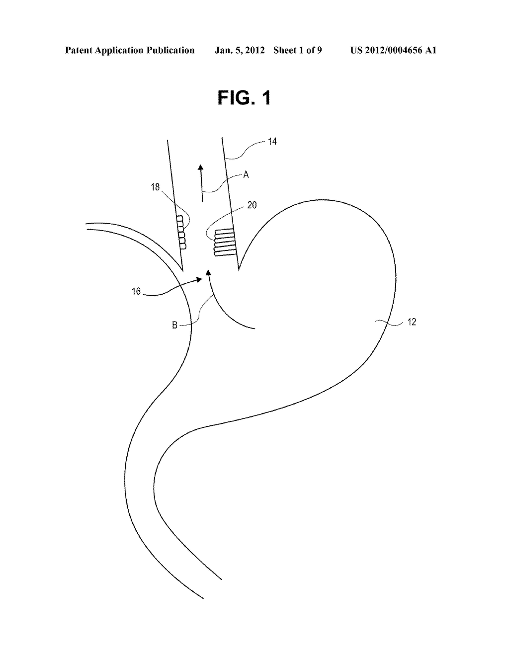 METHODS AND SYSTEMS FOR TREATMENT OF TISSUE IN A BODY LUMEN - diagram, schematic, and image 02