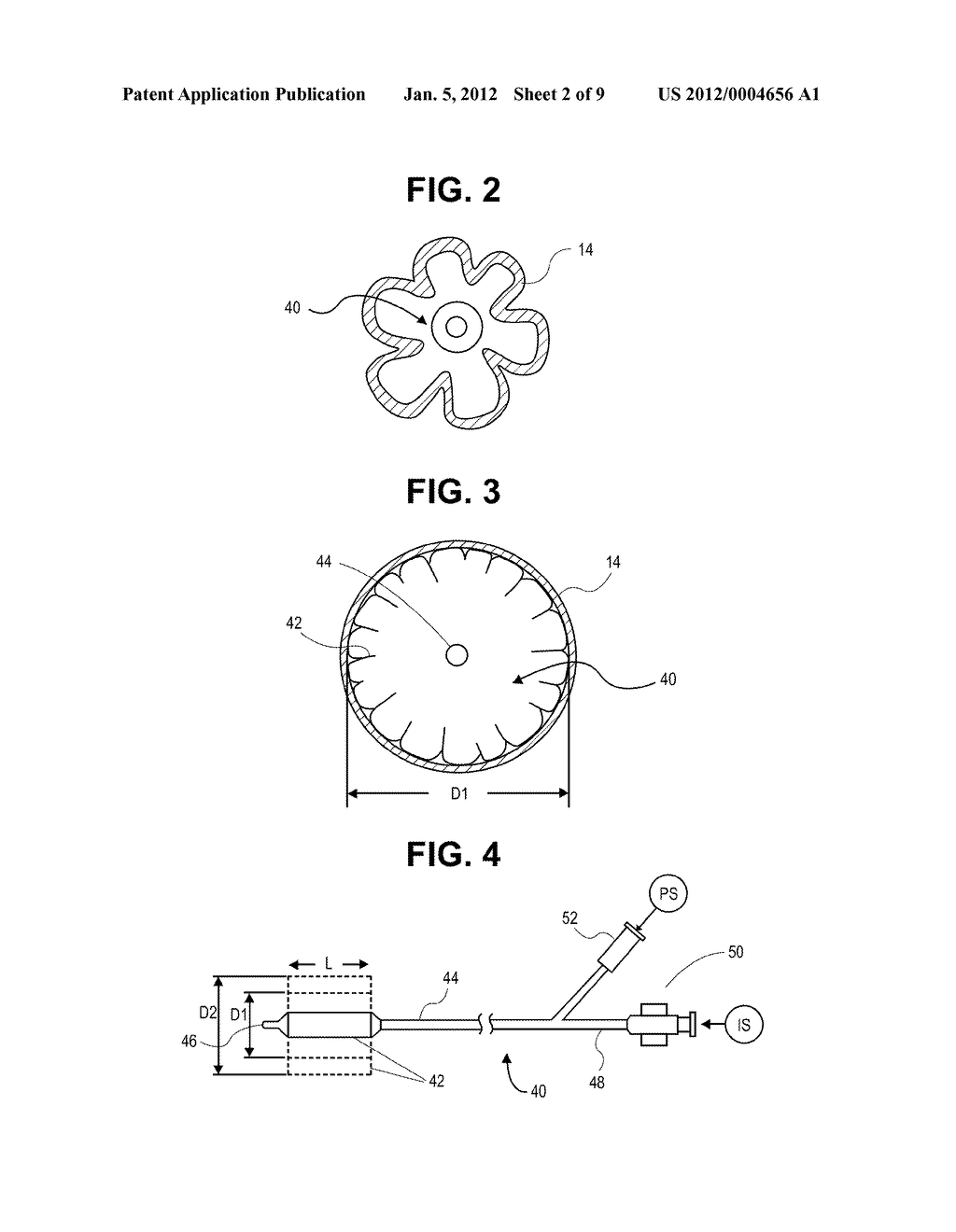 METHODS AND SYSTEMS FOR TREATMENT OF TISSUE IN A BODY LUMEN - diagram, schematic, and image 03