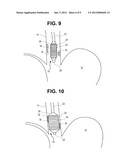 METHODS AND SYSTEMS FOR TREATMENT OF TISSUE IN A BODY LUMEN diagram and image