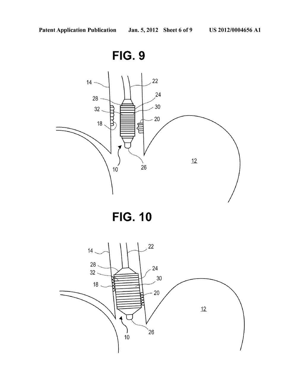 METHODS AND SYSTEMS FOR TREATMENT OF TISSUE IN A BODY LUMEN - diagram, schematic, and image 07