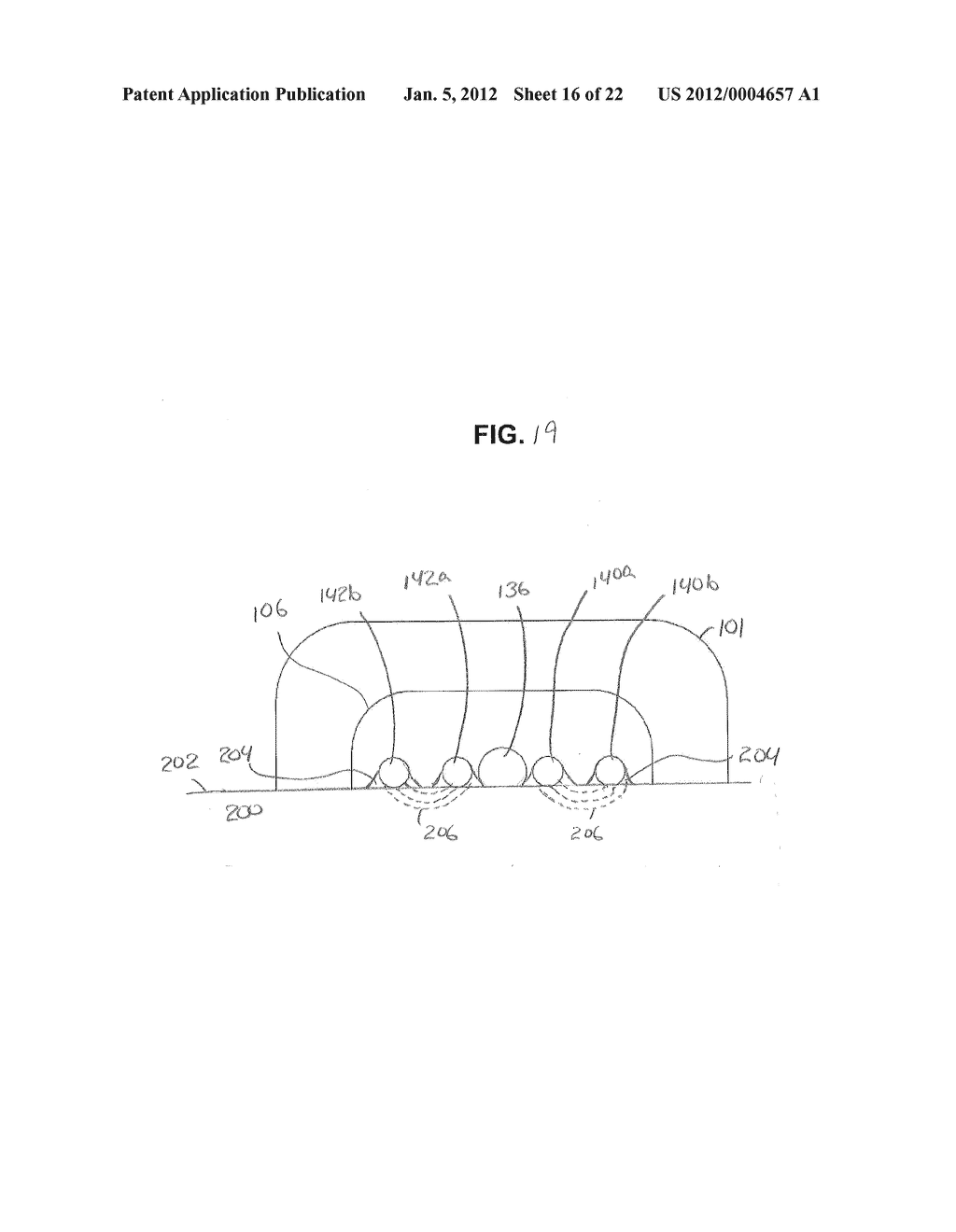 Electrosurgical Devices with Wire Electrode And Methods of Use Thereof - diagram, schematic, and image 17